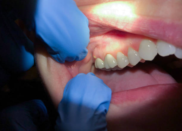 Best Emergency Tooth Extraction in Suffolk, VA